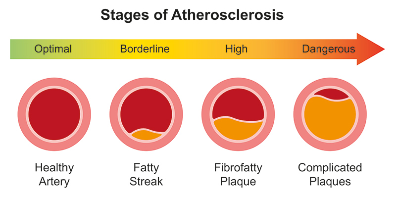 Stages of Atherosclerosis - The Breckinridge