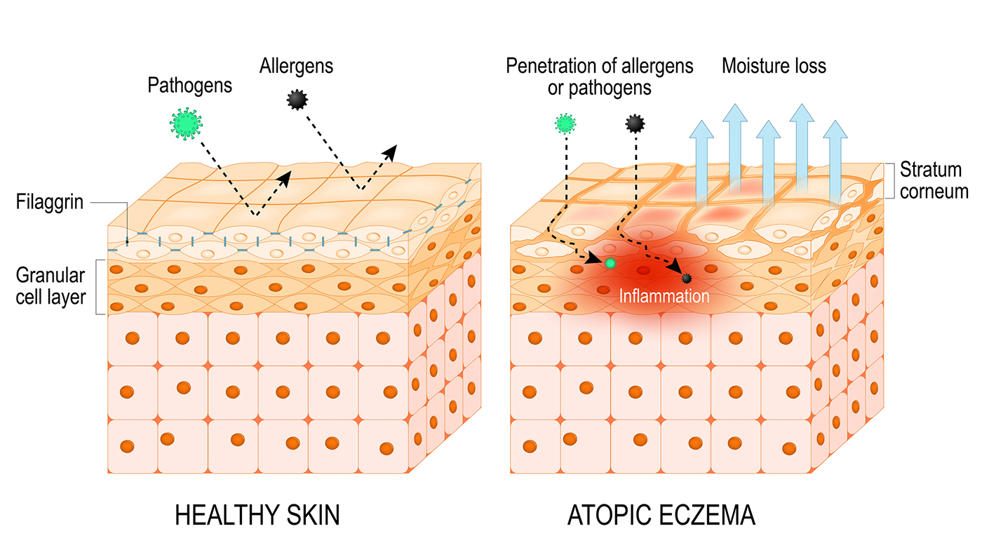 Signs of rosacea - Does our skin hold clues to dementia? - The Breckinridge Memory Care - Lexington, KY