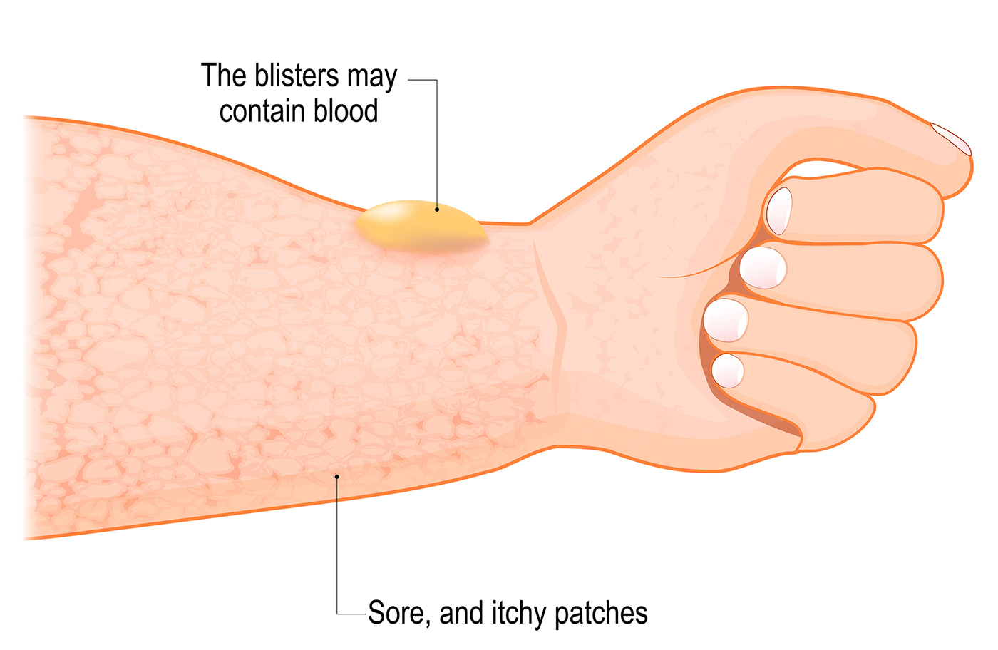 Signs of rosacea - Does our skin hold clues to dementia? - The Breckinridge Memory Care - Lexington, KY