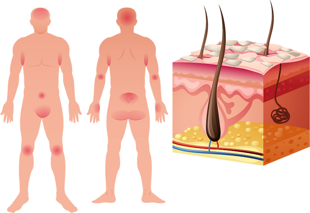 Signs of rosacea - Does our skin hold clues to dementia? - The Breckinridge Memory Care - Lexington, KY