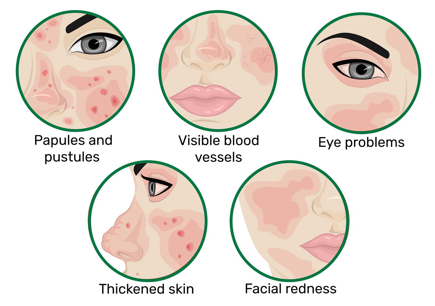 Signs of rosacea - Does our skin hold clues to dementia? - The Breckinridge Memory Care - Lexington, KY